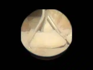 Wall Tie Fail - Poor Embedment