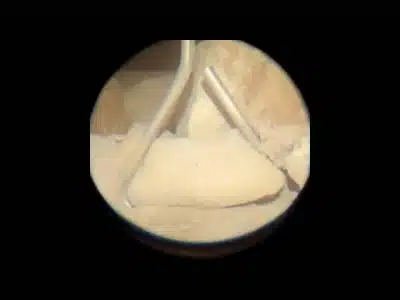 Wall Tie Fail - Poor Embedment